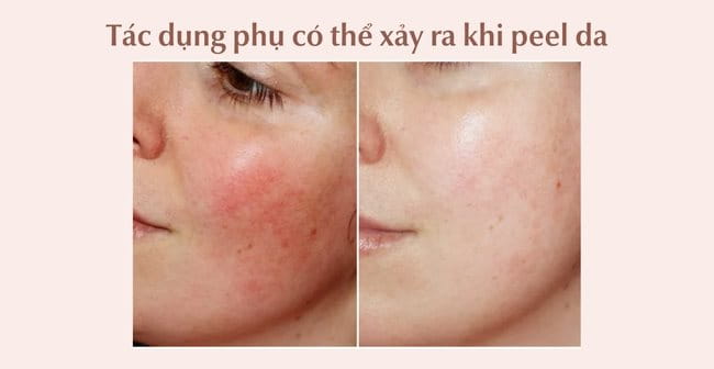 Peel Da Là Gì? Có Tốt Không? Quy Trình Peel Da Chuẩn Y Khoa A-Z
