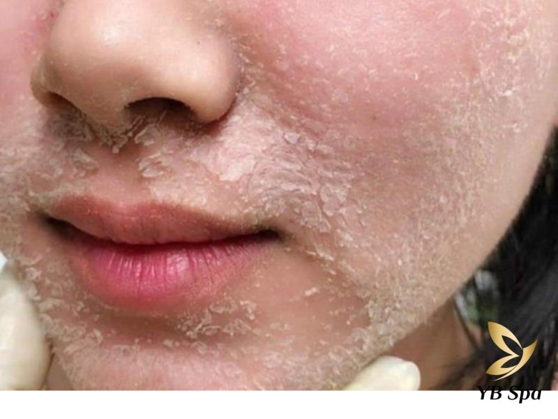 Peel da xong có nên đắp mặt nạ không? Nên đắp mặt nạ gì?