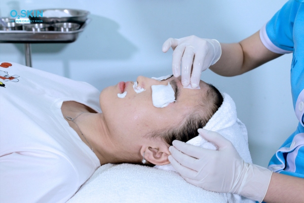 Sau khi peel da có nên đắp mặt nạ không? Lưu ý bạn nên biết