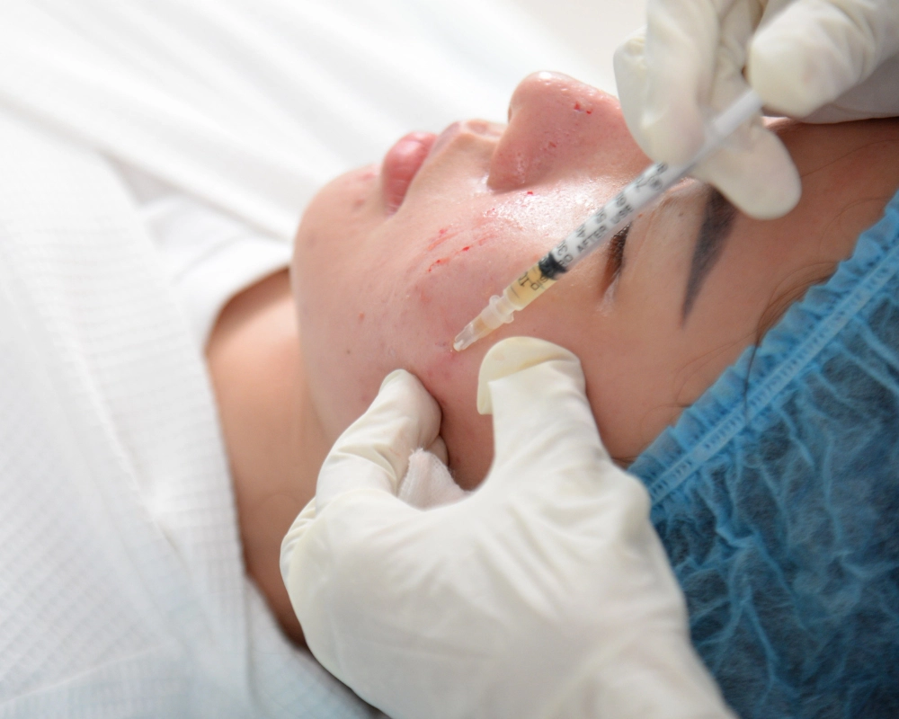 Điểm danh 05 tác dụng tuyệt vời của liệu pháp tiêm PRP cho da mặt