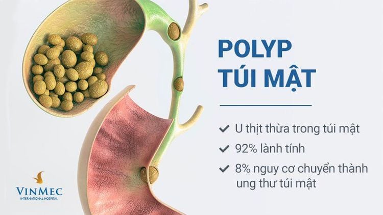 Đa polyp túi mật có nguy hiểm không?