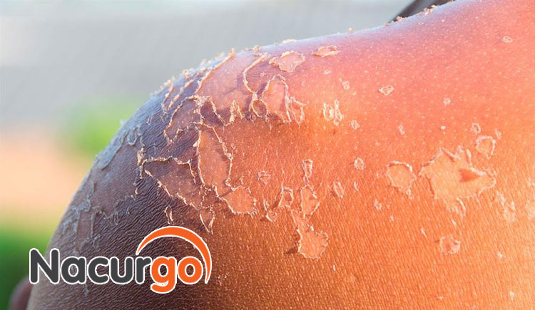 Bỏng da nhẹ ở mặt do đâu? Mách cách xử lý hiệu quả