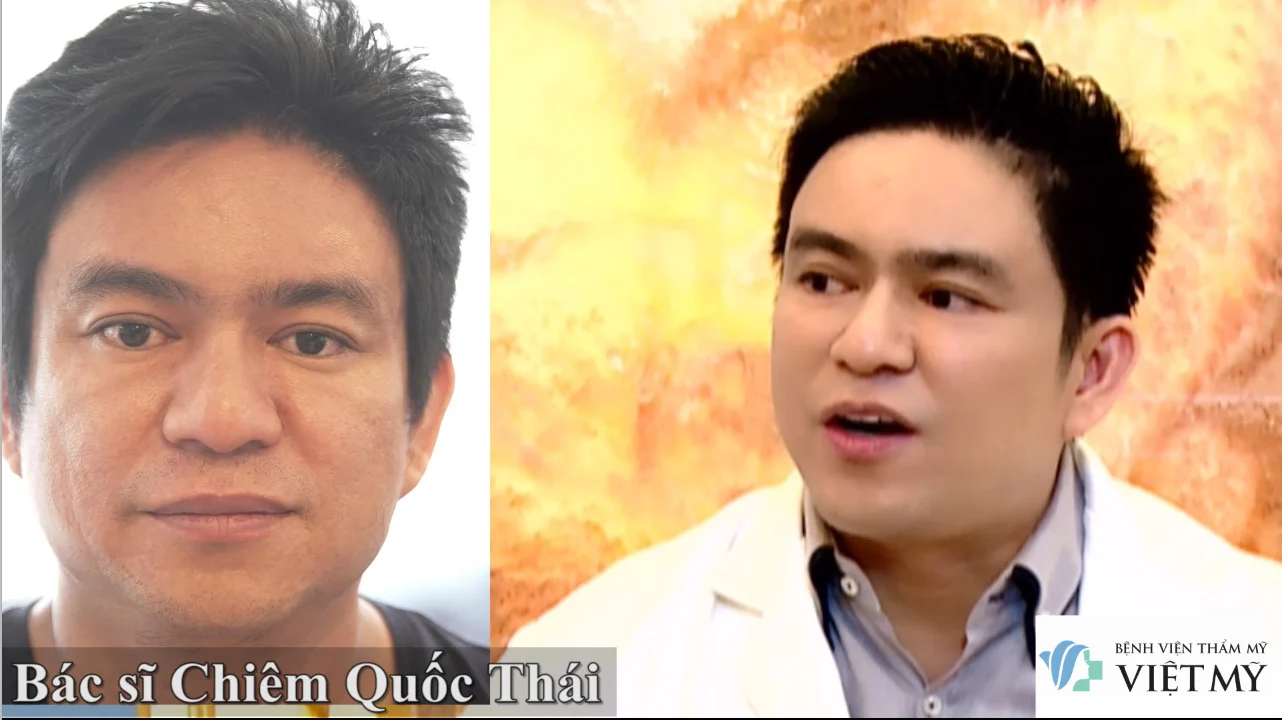 Căng da mặt bằng chỉ - bác sĩ Chiêm Quốc Thái - căng da mặt chỉ Collagen - căng da mặt chỉ vàng -chỉ The Up