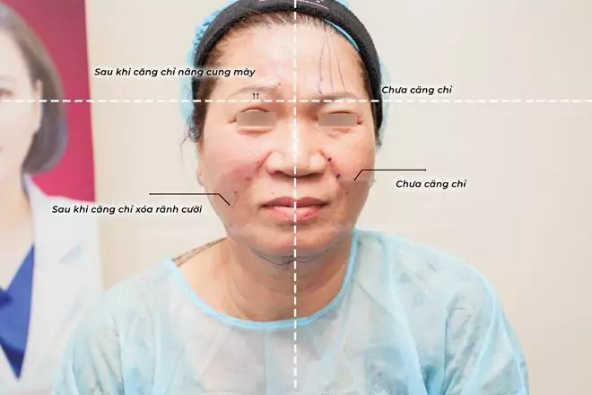 Căng chỉ da mặt bao lâu thì đẹp, cần kiêng cữ gì?