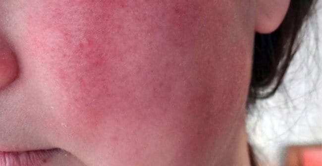 Da mặt bị đỏ (Rosacea): Nguyên nhân, biểu hiện, cách điều trị