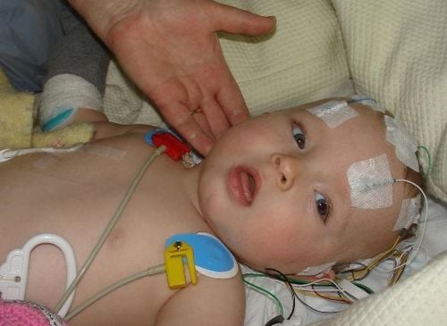 Hình ảnh bệnh tay chân miệng theo từng giai đoạn bệnh