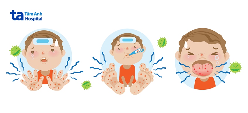 Tay chân miệng ở trẻ: Nguyên nhân và cách nhận biết