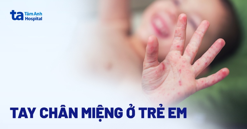 Tay chân miệng ở trẻ: Nguyên nhân và cách nhận biết