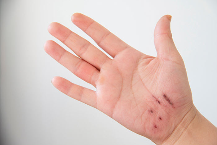 Hình ảnh tay nhẹ bị xước