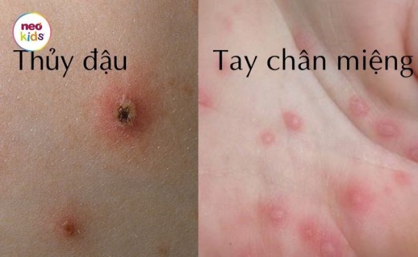 Hình ảnh bệnh tay chân miệng ở trẻ em - dấu hiệu nhận diện và phân biệt