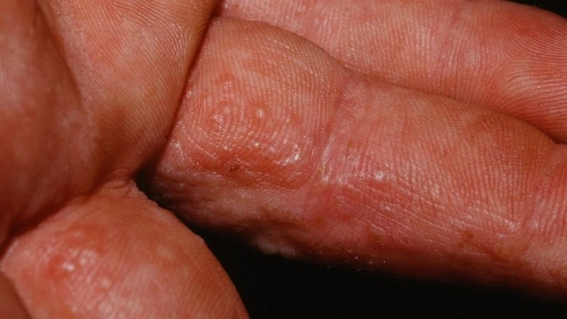 Bệnh tổ đỉa có lây không? Nguyên nhân và cách điều trị tổ đỉa