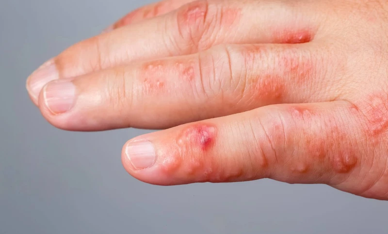 Ghẻ nước ở tay: Nguyên nhân, triệu chứng và phương pháp điều trị