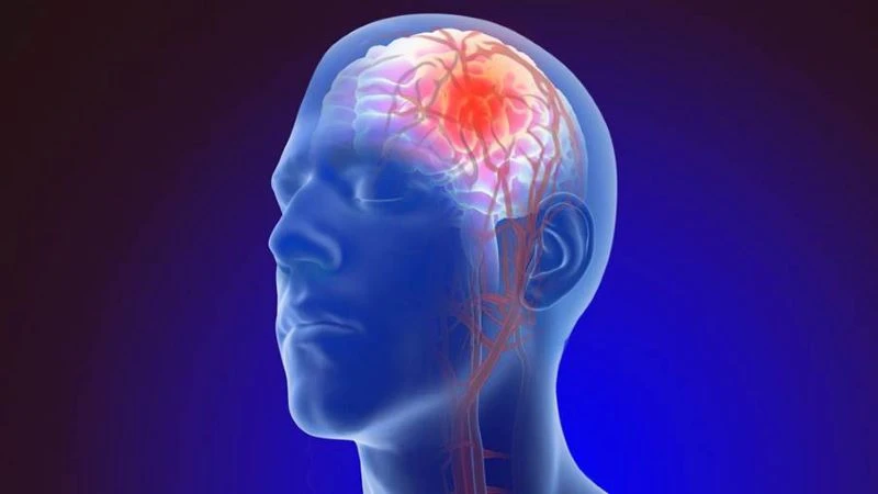 Hệ quả nghiêm trọng của đứt mạch máu