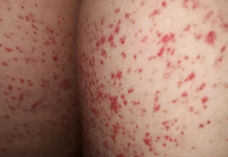 Nguyên nhân và cách điều trị lòng bàn tay nổi đốm đỏ không ngứa