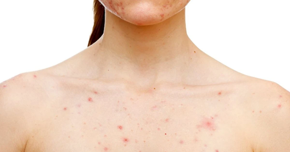 Hiểu về tay nổi mẩn đỏ không ngứa và cách xử lý