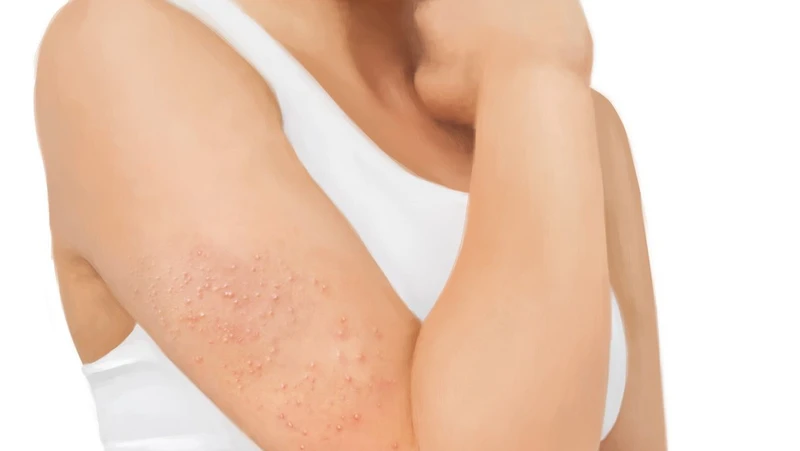 Nguyên nhân cánh tay nổi mụn nhỏ và cách điều trị hiệu quả