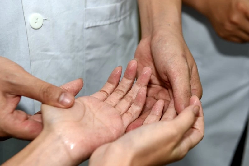 Những điều bạn cần biết về hội chứng đổ mồ hôi tay chân