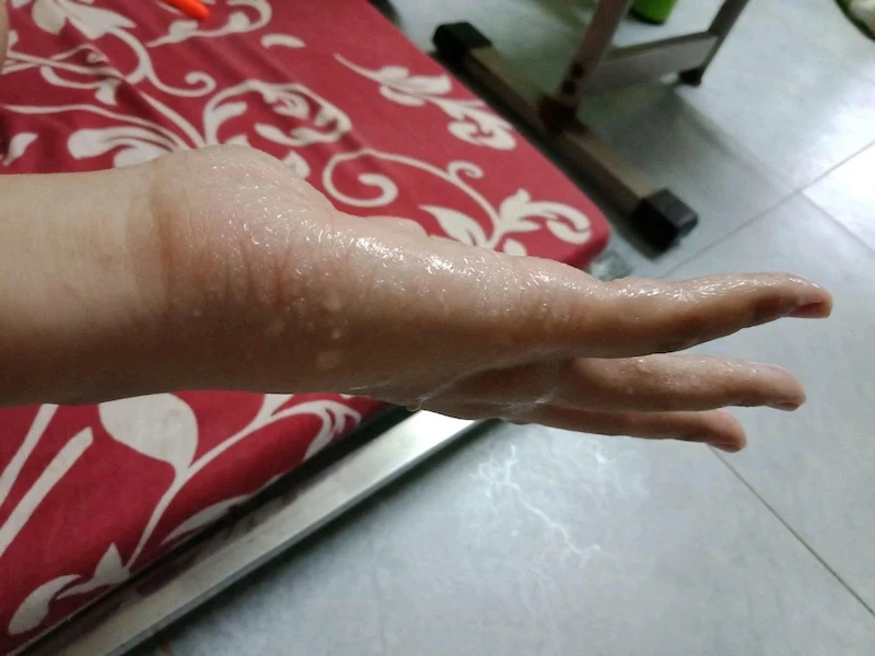 Những điều bạn cần biết về hội chứng đổ mồ hôi tay chân