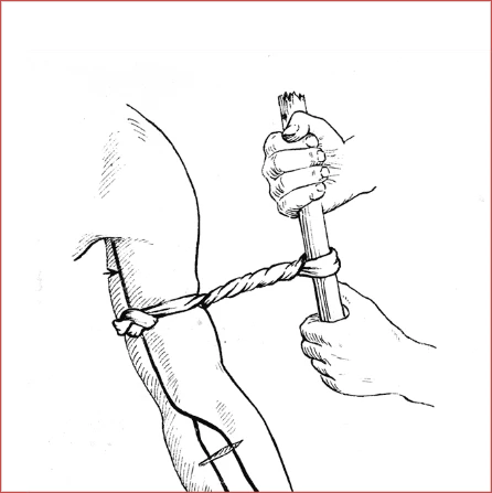 Cách sơ cứu khi bị vết thương gây chảy máu bên ngoài