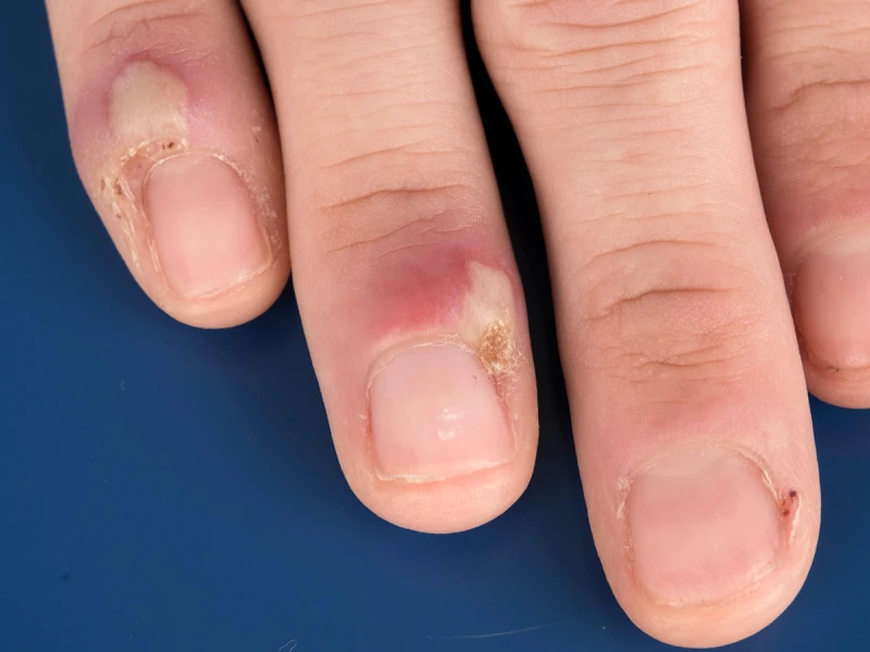 Ngón tay bị sưng mủ phải làm sao để điều trị kịp thời