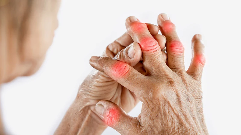 Nguyên nhân và cách điều trị ngón tay bị sưng phù ngứa