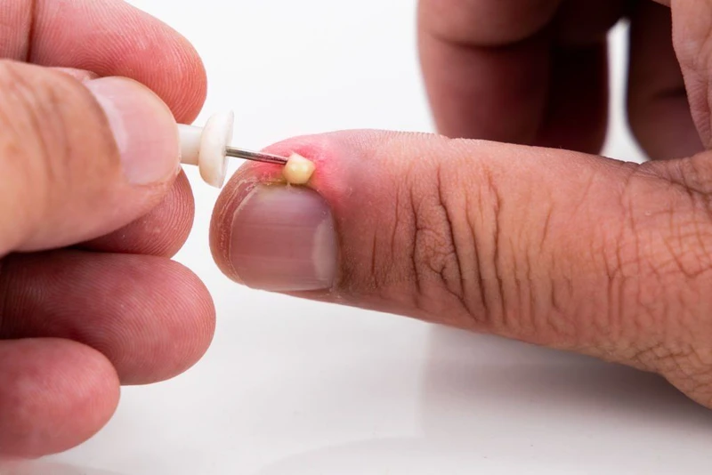 Làm gì khi đầu ngón tay bị sưng và có mủ?