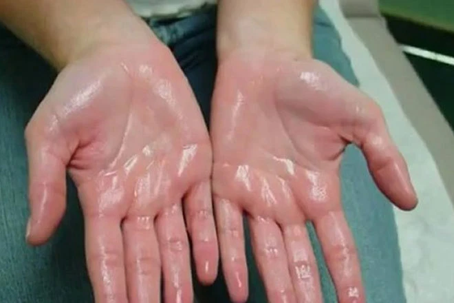 Chảy mồ hôi ở tay và chân là bệnh gì? - Y Khoa Diamond