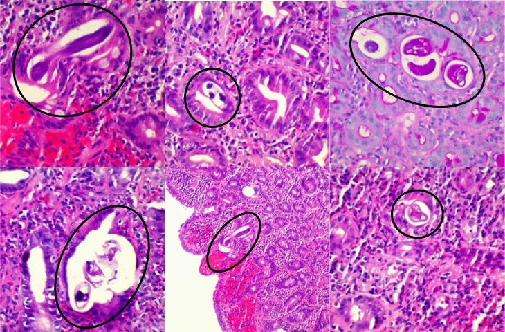 20 năm không tẩy giun, bệnh nhân 60 tuổi loét dạ dày, viêm tá tràng vì nhiễm giun lươn