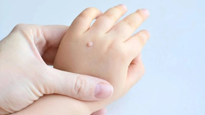 Dấu hiệu nhận biết sùi mào gà ở tay