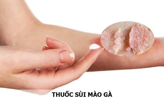 Dấu hiệu nhận biết sùi mào gà ở tay