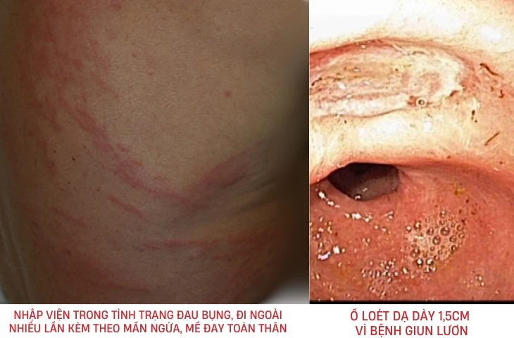 Lâu không tẩy giun có sao không? Tìm hiểu sự nguy hiểm