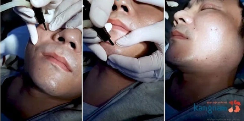 Tẩy nốt ruồi ở đâu tốt? Top 4 bệnh viện đáng tin cậy ở TPHCM