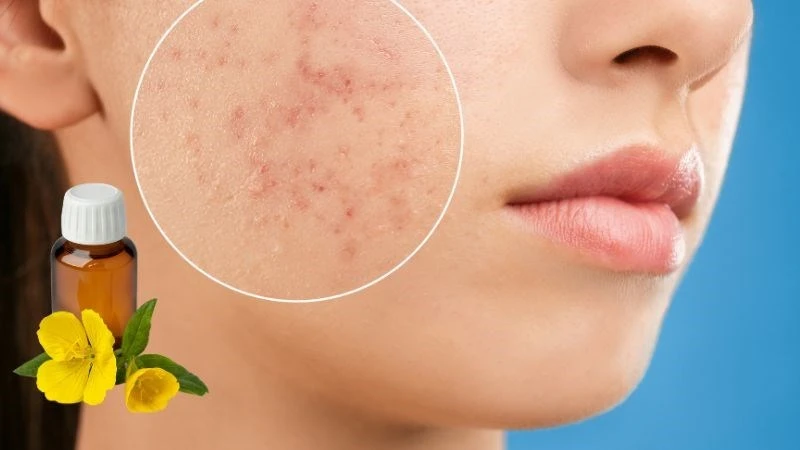 Tinh dầu hoa anh thảo là gì? 10 tác dụng, cách dùng và lưu ý khi sử dụng