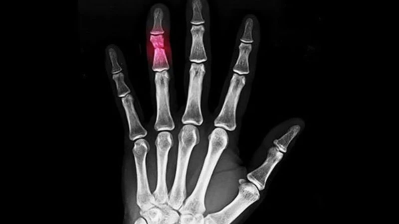 Hiểu về trật khớp ngón tay và cách điều trị hiệu quả