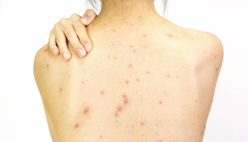 Giải pháp hiệu quả cho mụn lưng tại tiệm thuốc tây