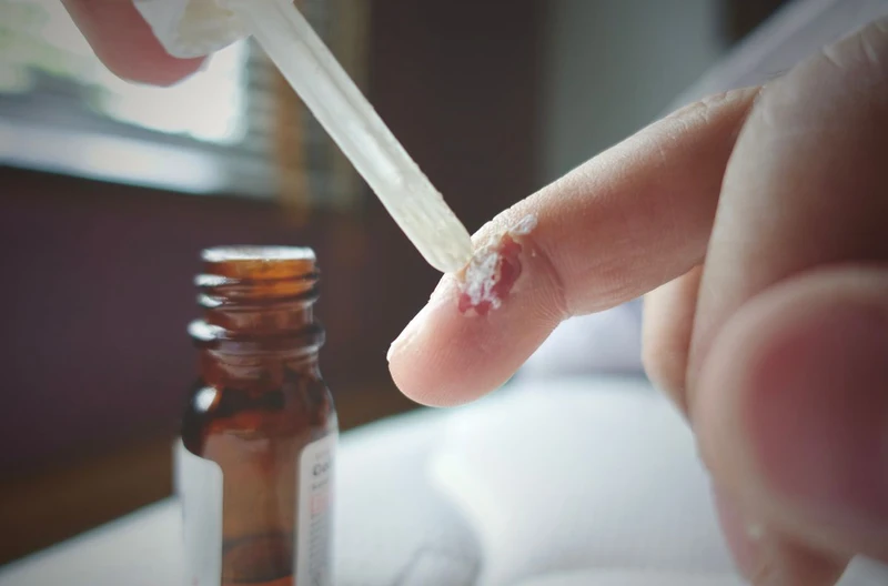 Tay nổi mụn cứng có sao không? Nguyên nhân và cách điều trị hiệu quả