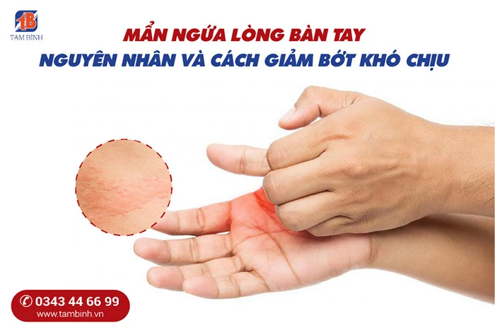 Mẹo chữa ngứa lòng bàn tay hiệu quả và an toàn