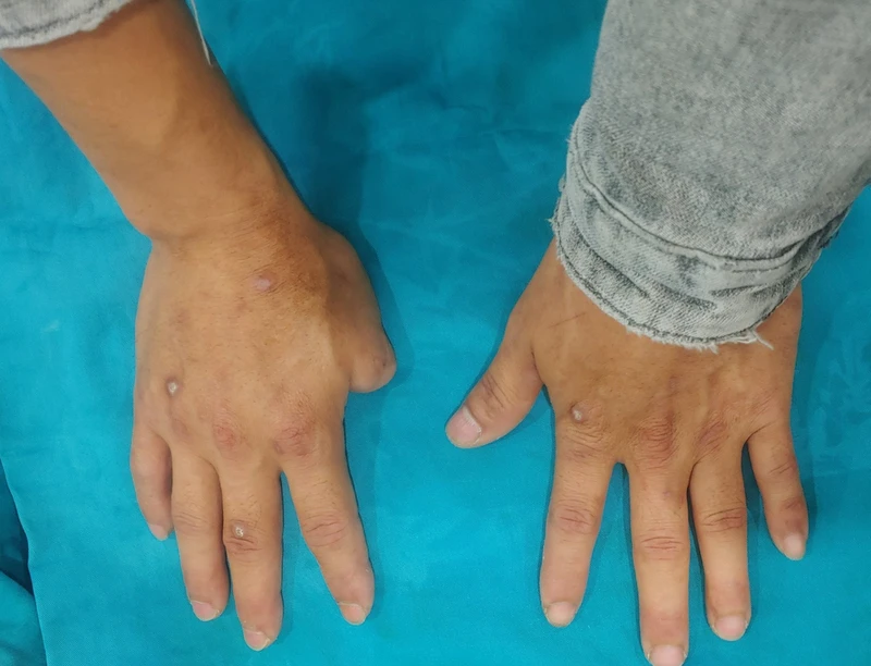 Hiểu về tình trạng cụt tay và ảnh hưởng đến cuộc sống