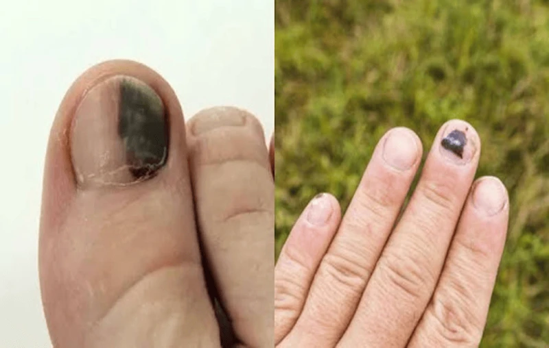 Nguyên nhân và cách xử lý móng tay bị đen