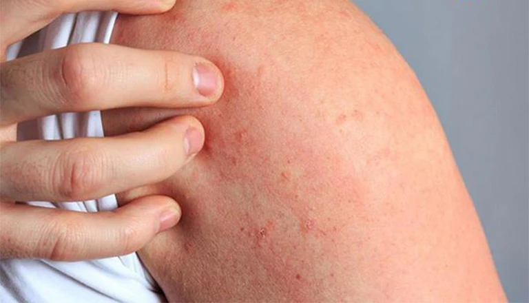 Thắc mắc: Da nổi chấm đỏ như nốt ruồi son không ngứa là bị gì?