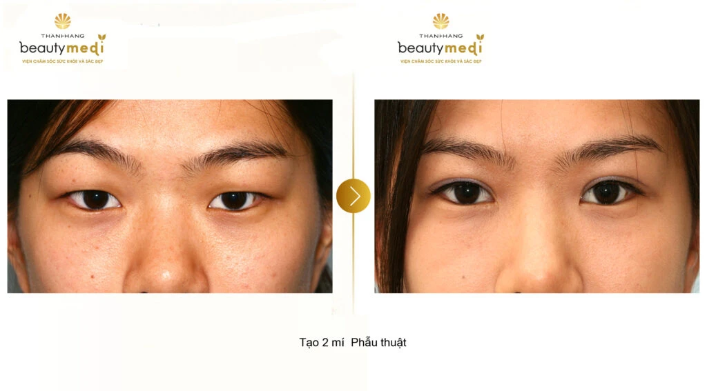 Mắt hoa đào là gì? Ý nghĩa tướng số của nam nữ mắt hoa anh đào