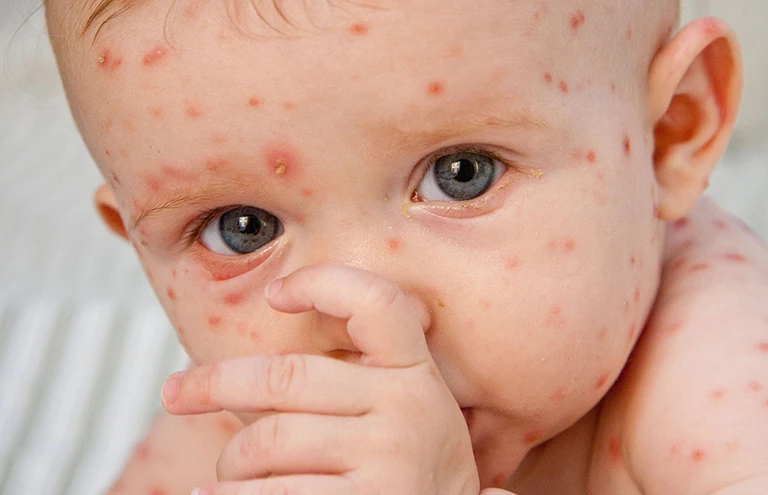 Thắc mắc: Da nổi chấm đỏ như nốt ruồi son không ngứa là bị gì?