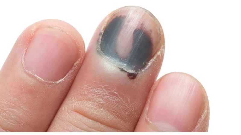 Nhận biết ung thư hắc tô móng tay sớm và hiệu quả