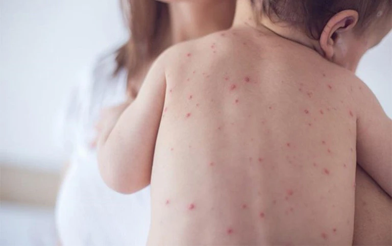 Nguyên nhân gây tay nổi chấm đỏ không ngứa