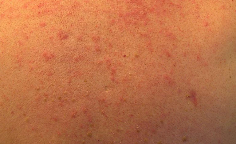 Thắc mắc: Da nổi chấm đỏ như nốt ruồi son không ngứa là bị gì?