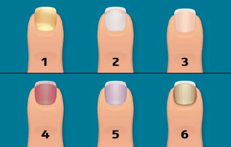 Móng tay đen là biểu hiện của bệnh gì?