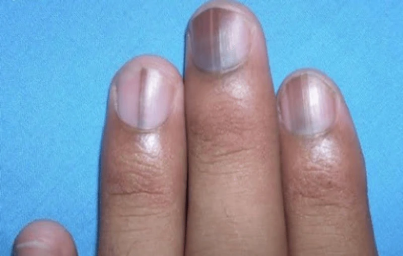 Móng tay đen là biểu hiện của bệnh gì?