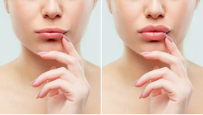 Tiêm môi tây: Tạo dáng quyến rũ cho khuôn mặt bạn