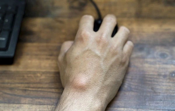 U nang bao hoạt dịch cổ tay: Thông tin cần biết