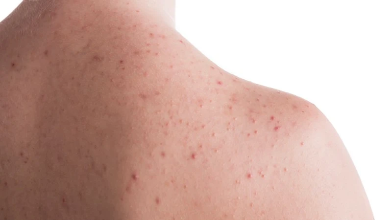 Viêm nang lông: Nguyên nhân, dấu hiệu và cách điều trị hiệu quả